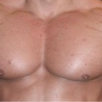 Männer die Dehnungsstreifen durch Muskelaufbau bekommen, bekommen diese oft unter den Achseln. Bildquelle: http://bodybuilding-mauritius.blogspot.de/2013/02/stretch-marks-and-bodybuilder.html