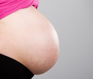Dehnungsstreifen durch eine Schwangerschaft werden Schwangerschaftsstreifen genannt.